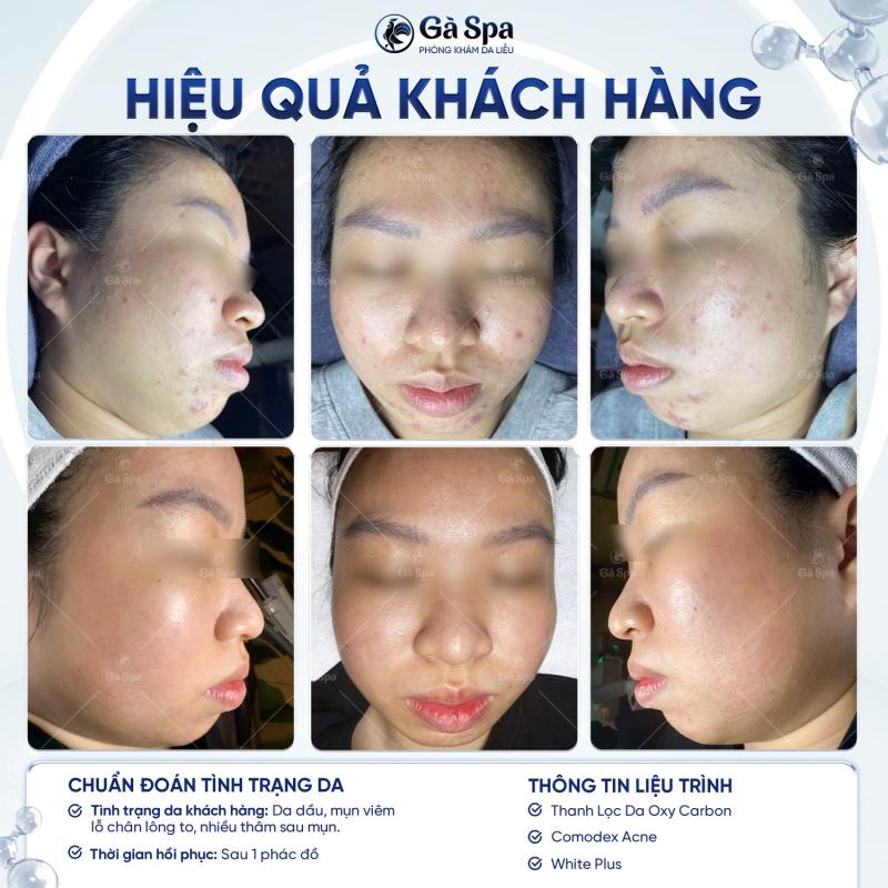 Gà Clinic & Beauty Spa Biên Hòa - Địa Chỉ Trị Mụn Uy Tín, Chuẩn Y Khoa