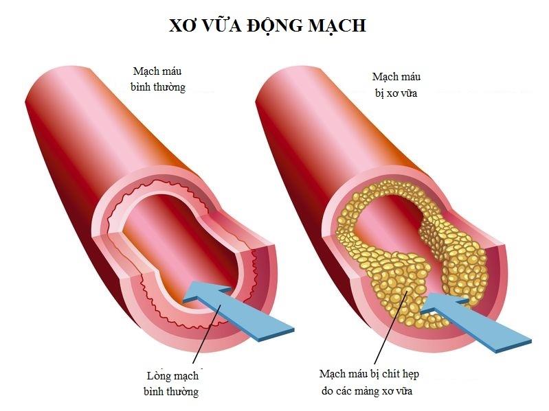 Bệnh xơ vữa động mạch