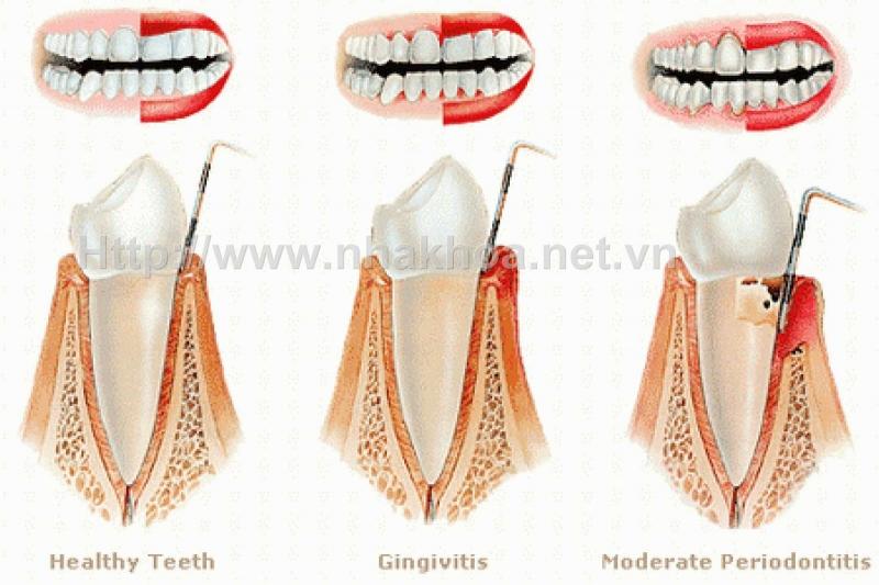 Ngăn chặn cơ chế phát triển của các gốc tự do