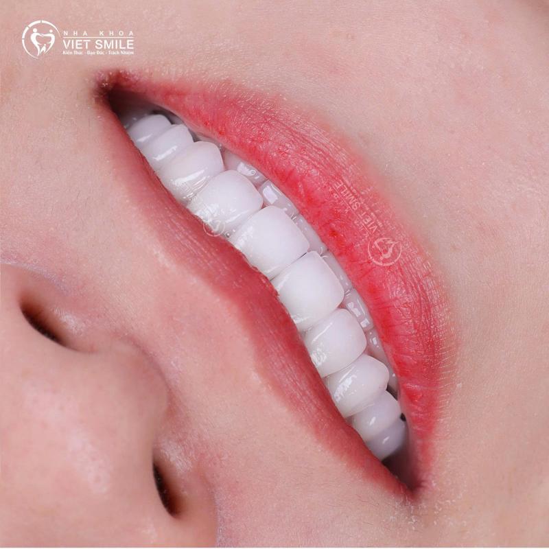 Nha khoa Vi﻿﻿ệt Smile