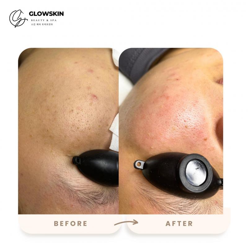 GlowSkin Beauty & Spa - Spa Trị Mụn Hiệu Quả Được Khách Hàng Tin Chọn