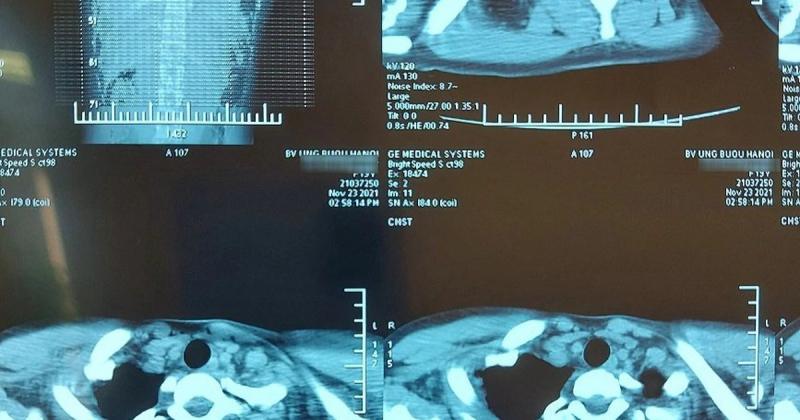 Hình ảnh siêu âm khối u (Ảnh: Dân Trí)
