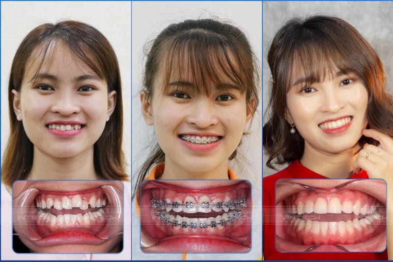 Khách hàng niềng răng thành công tại Lạc Việt Intech