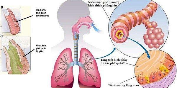 Hen phế quản còn gọi là hen suyễn