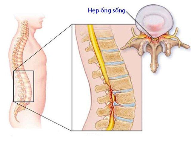 Hẹp ống sống