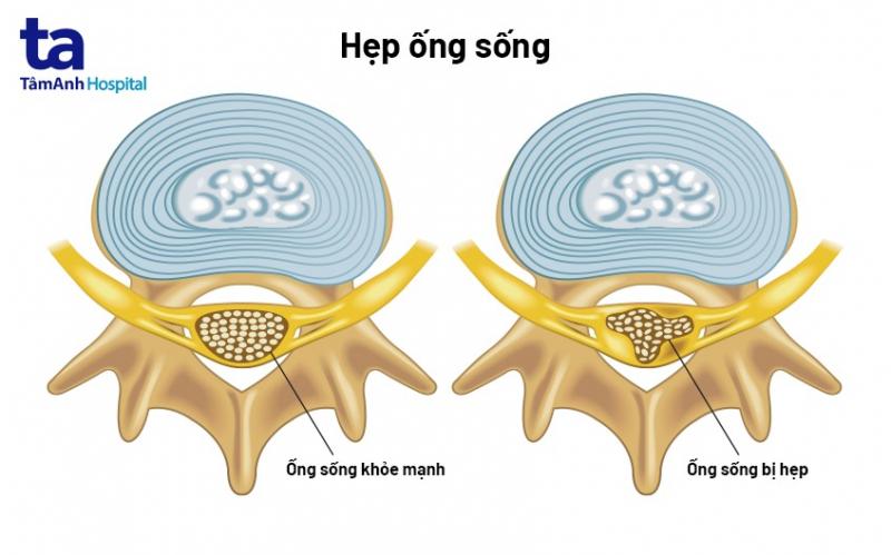 Hẹp ống sống