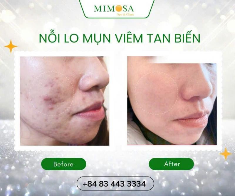 Hien Mimosa Spa & Clinic