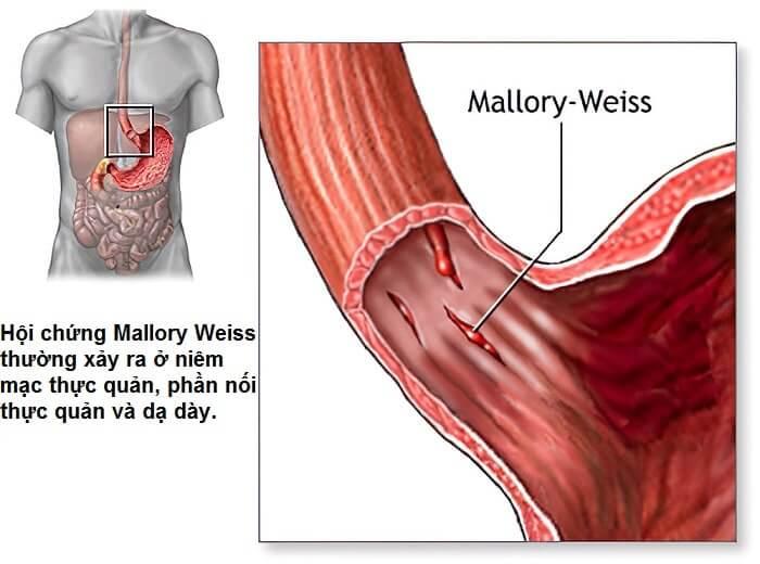 Hội chứng Mallory Weiss