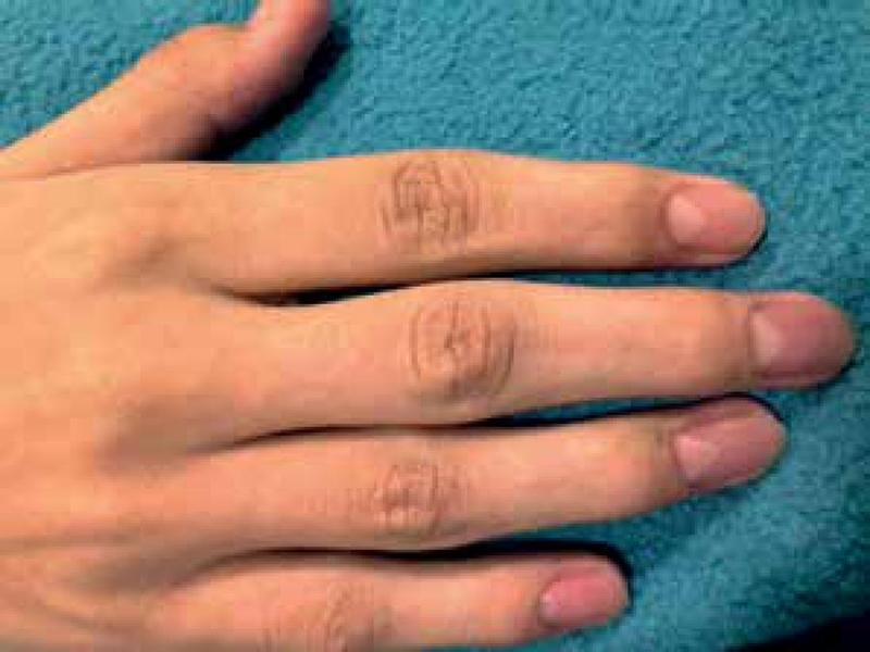 Hội chứng móng tay xương bánh chè (nail-patella syndrome)