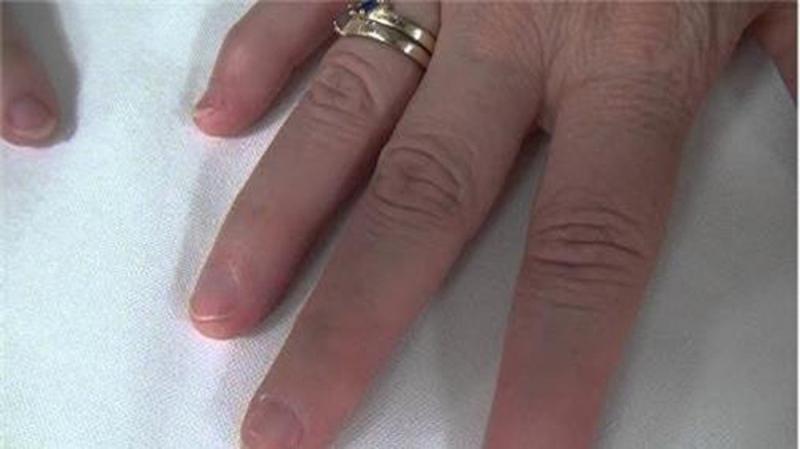 Hội chứng móng tay xương bánh chè (nail-patella syndrome)