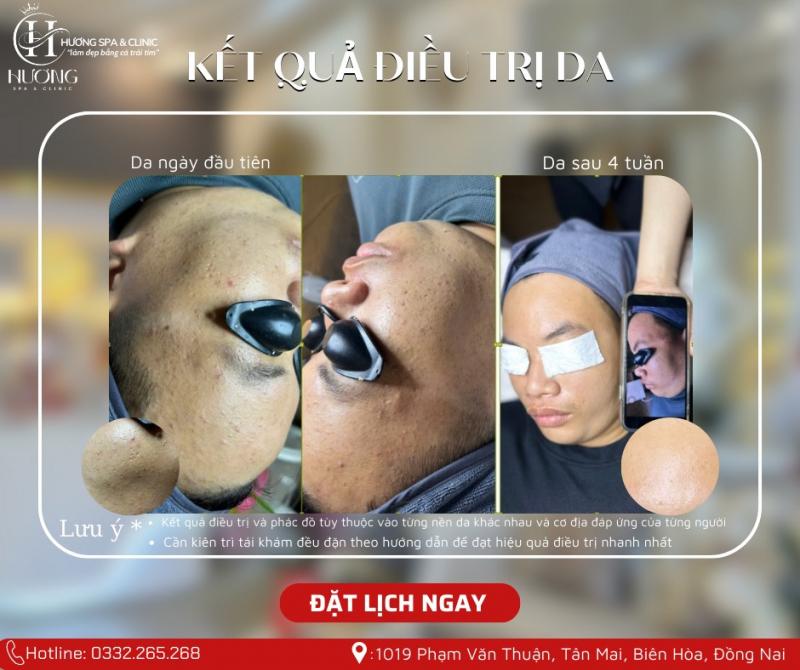 Hương Spa Clinic - Spa Trị Mụn Hiệu Quả, Được Đánh Giá Cao Ở Đồng Nai