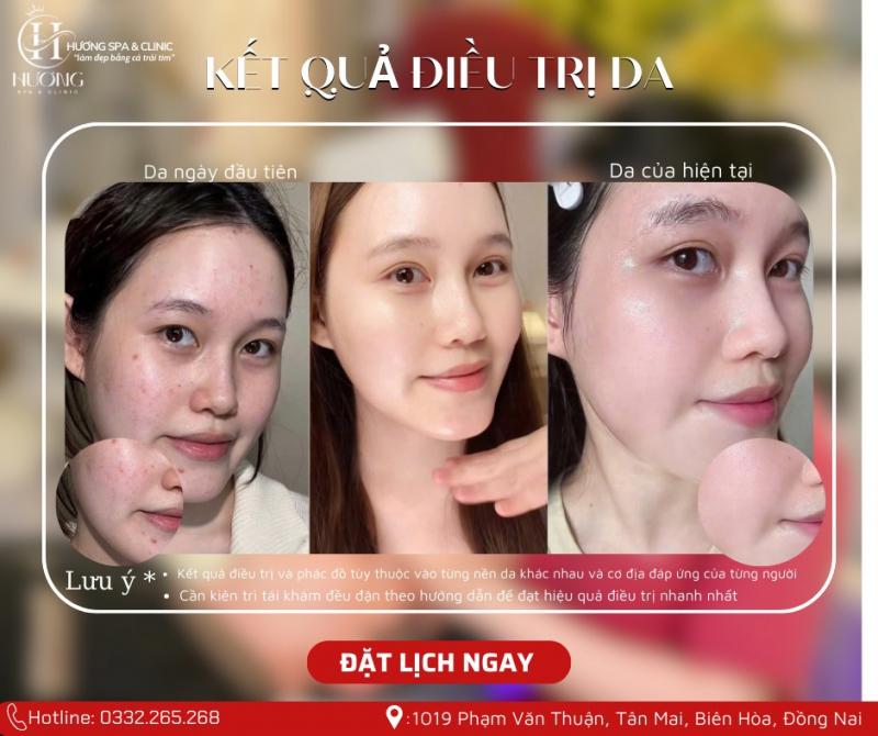 Hương Spa Clinic - Spa Trị Mụn Hiệu Quả, Được Đánh Giá Cao Ở Đồng Nai