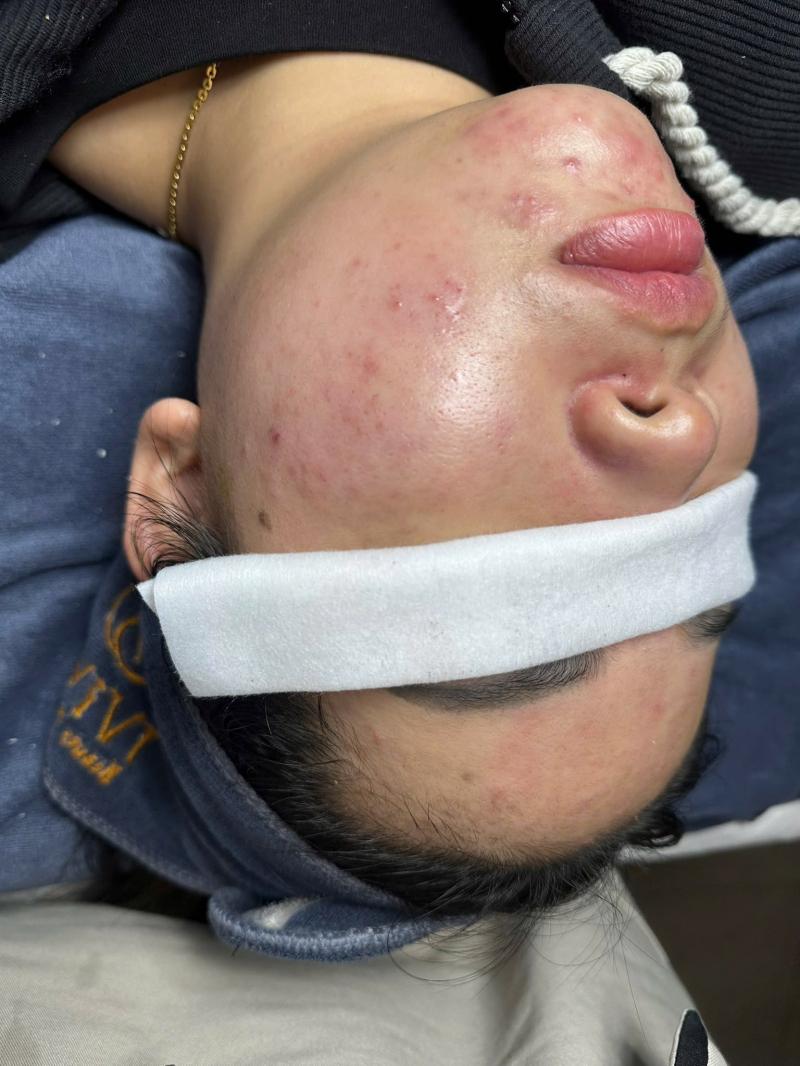 IViVi Beauty Spa Biên Hoà - Địa Chỉ Trị Mụn Uy Tín Đồng Nai Với Liệu Trình Chuẩn Y Khoa