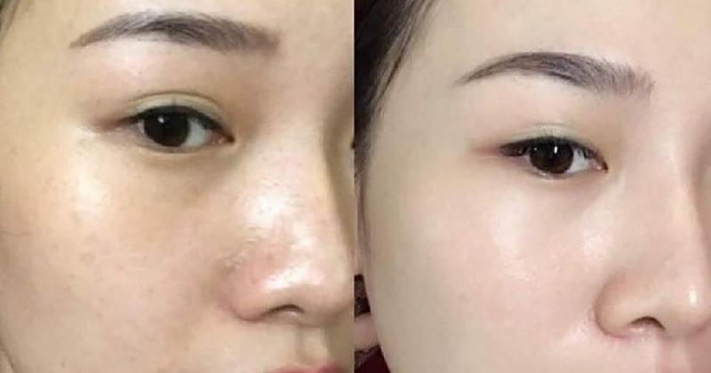 Kem dưỡng ẩm chuyên sâu và chống lão hóa 82X Al Stem Cell Cream