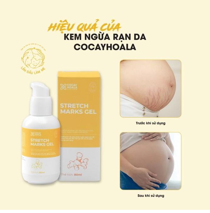 Kem ngừa rạn da gel nghệ Cocayhoala