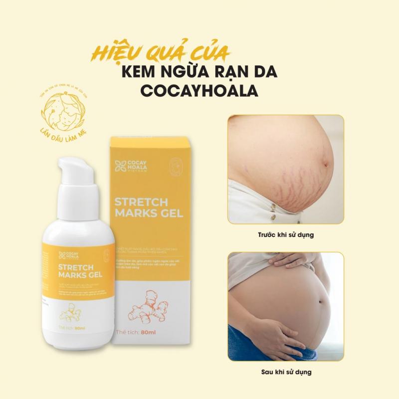 Kem ngừa rạn gel nghệ Cỏ Cây Hoa Lá