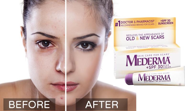 Kem trị sẹo Mederma