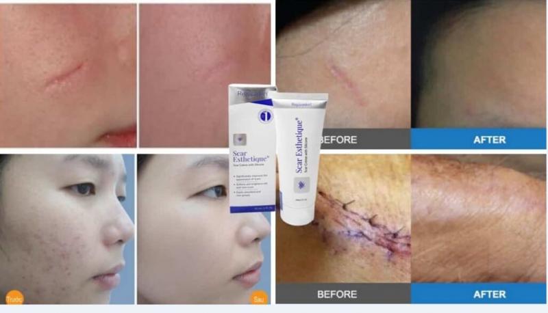 Kem trị sẹo Scar Esthetique