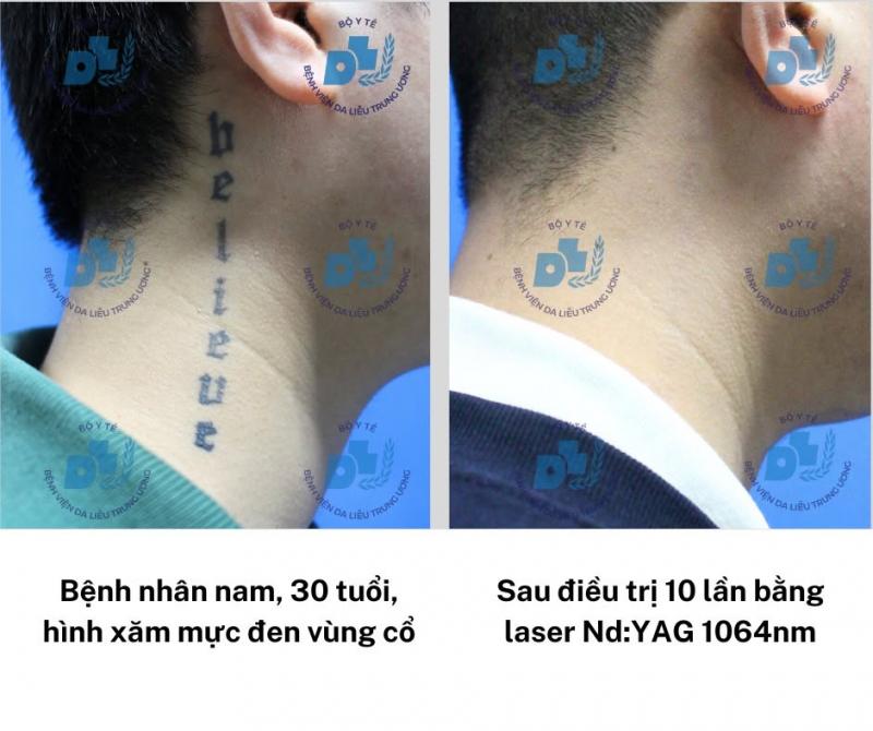 Khoa Laser và Săn sóc da – Bệnh viện Da liễu Trung ương