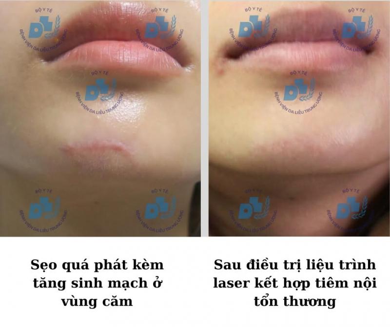 Khoa Laser và Săn sóc da – Bệnh viện Da liễu Trung ương