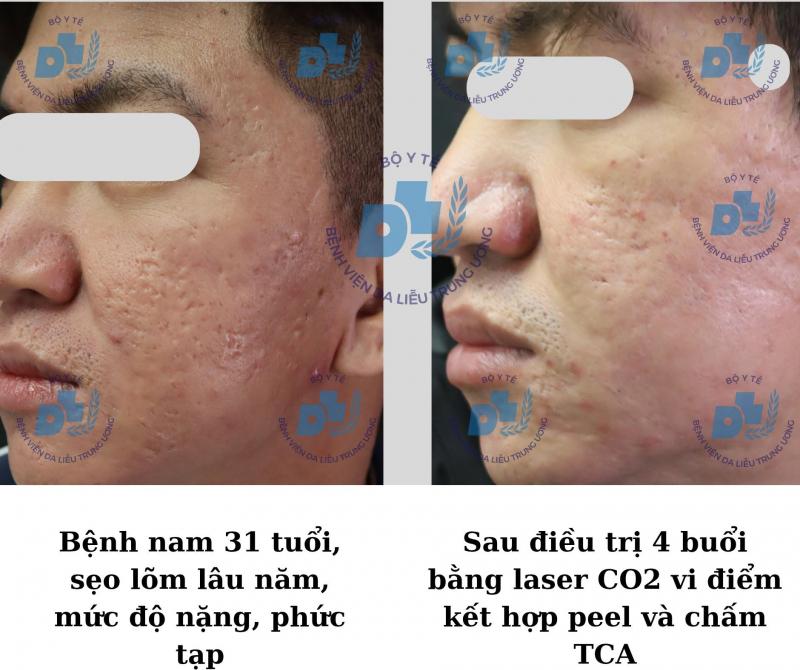 Khoa Laser và Săn sóc da – Bệnh viện Da liễu Trung ương