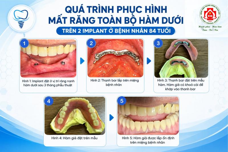 Quá trình phục hình mất răng toàn bộ hàm dưới trên Implant cho bệnh nhân 84 tuổi