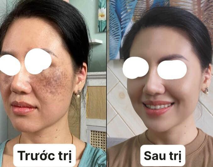 Kim Tiến Trị Nám Mụn