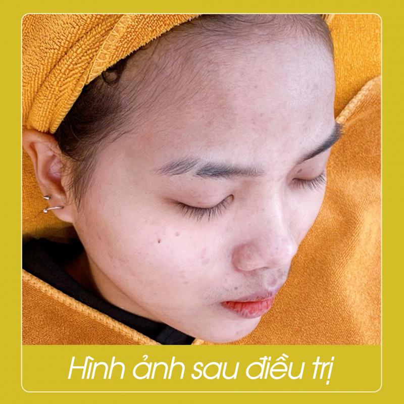 La Beauty - Spa Trị Mụn Tại Đà Nẵng
