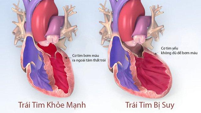 Làm gì để phòng ngừa bệnh lý tim mạch?