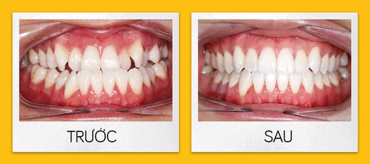 Quá trình làm niềng răng trong suốt Invisalign kéo dài bao lâu?