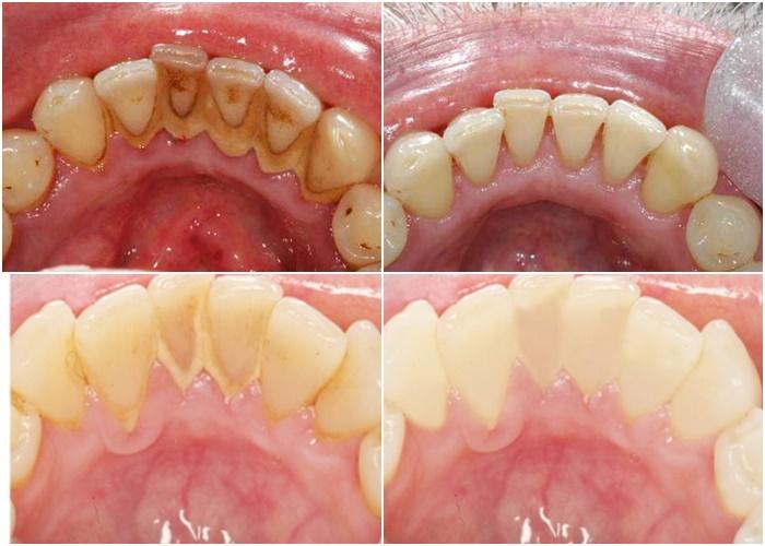 Trước và sau khi lấy cao răng