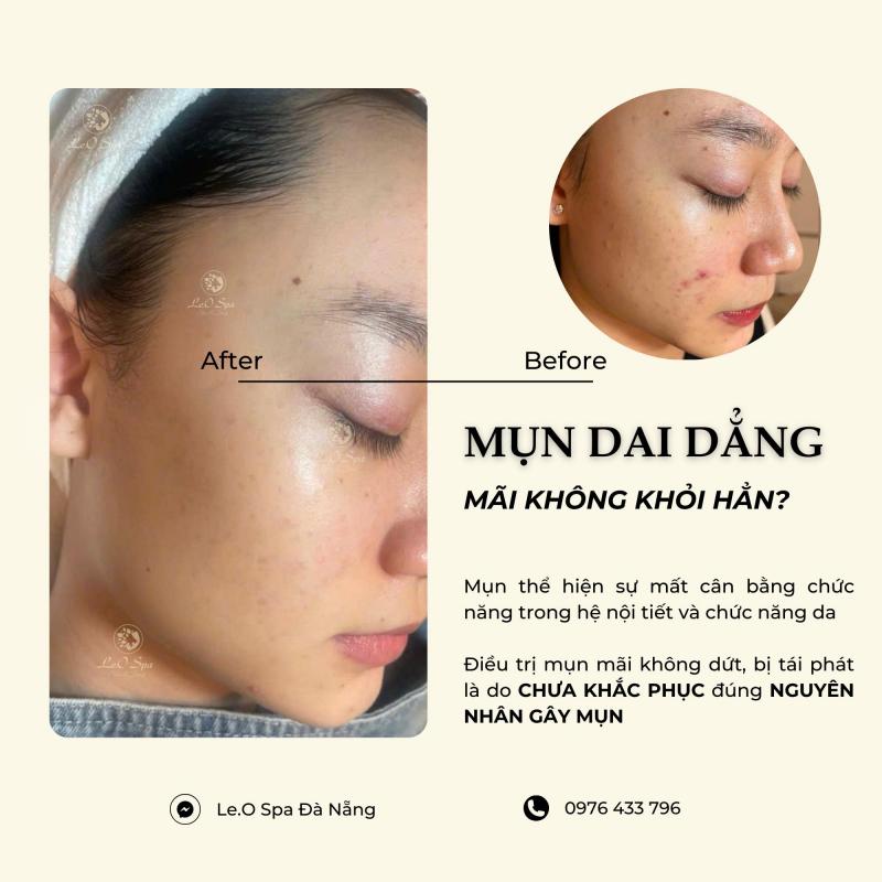 Le.O Spa Đà Nẵng - Spa Trị Mụn Uy Tín Có Cam Kết Bằng Văn Bản
