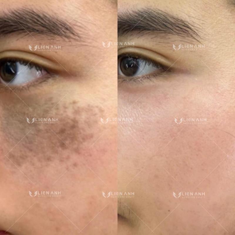 Lien Anh Clinic and Beauty - Trị Nám Chuyên Nghiệp Tại Đà Nẵng