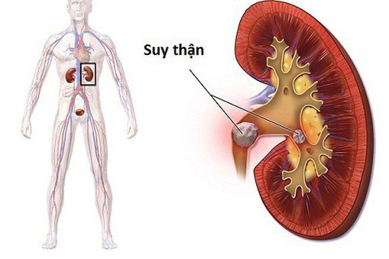 Người suy thận có liều lượng dùng riêng