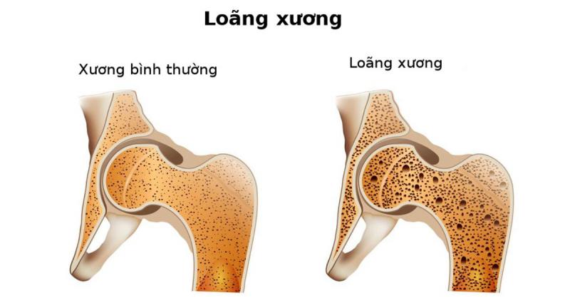 Loãng xương