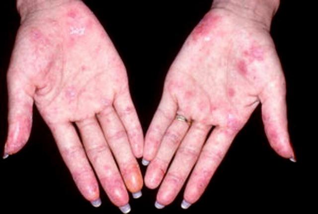 Lupus ban đỏ hệ thống là bệnh hiểm nghèo thường gặp ở trẻ em