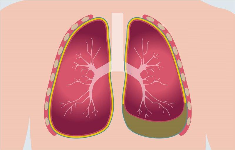 Bệnh viêm màng phổi có lây không?