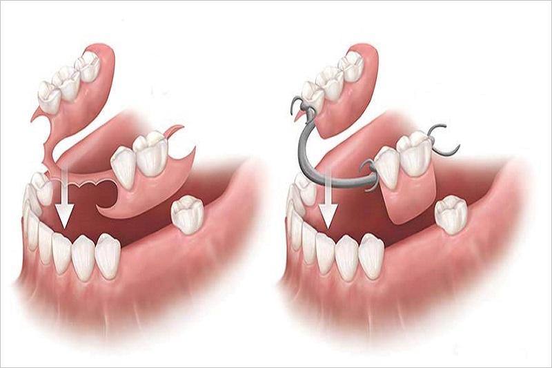 Răng giả tháo lắp là gì?