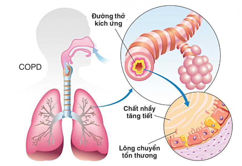 Có nguy cơ biến chứng đường hô hấp, suy giảm hô hấp và ngừng thở