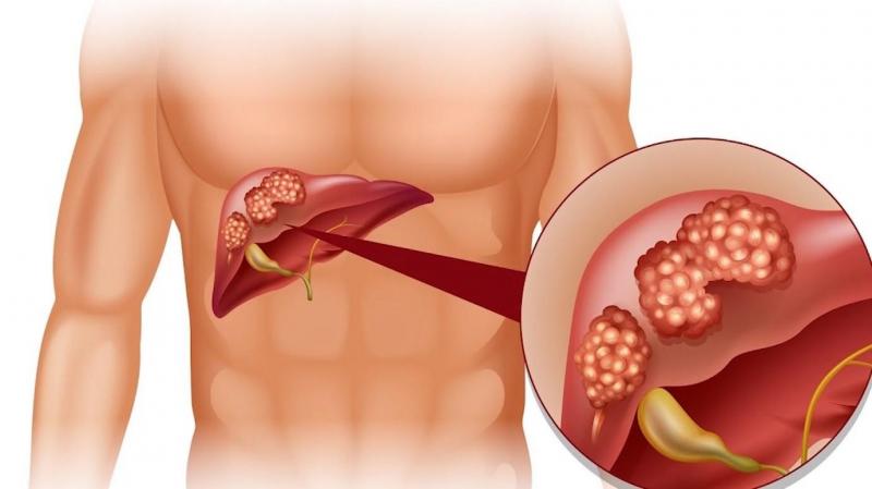 Bệnh nhân suy giảm chức năng gan, nồng độ các men gan phải được theo dõi cẩn thận