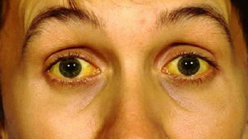 Khi cơ thể mệt mỏi hoặc thiếu ngủ, mắt bạn có thể chuyển sang màu vàng mờ.