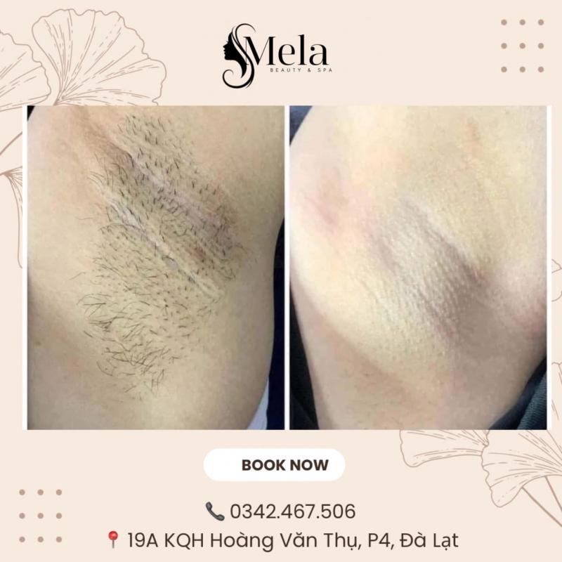 Mela Beauty & Spa - Spa Triệt Lông Chất Lượng Cao