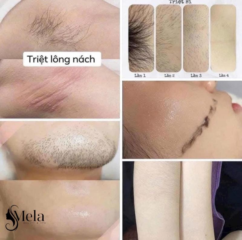 Mela Beauty & Spa - Spa Triệt Lông Chất Lượng Cao