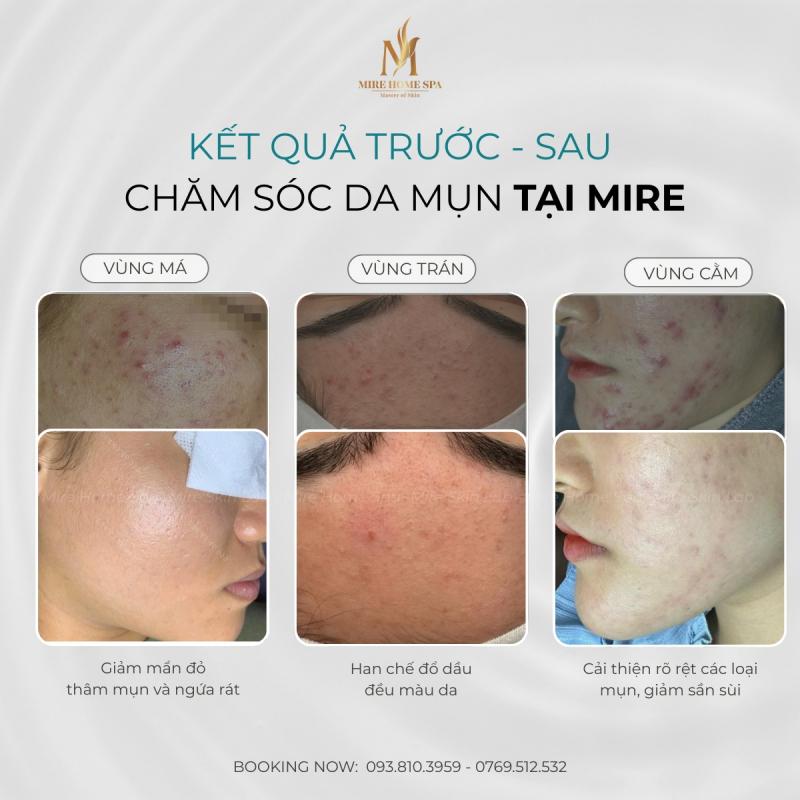 MiRe Home Spa - Chuyên Gia Trị Mụn Hàng Đầu Nha Trang