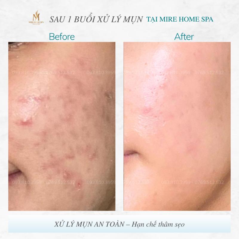 MiRe Home Spa - Chuyên Gia Trị Mụn Hàng Đầu Nha Trang