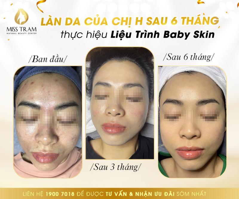 Miss Trâm – Natural Beauty Center: Nơi chuyên trị mụn, thâm sẹo rỗ uy tín có cam kết ở TpHCM