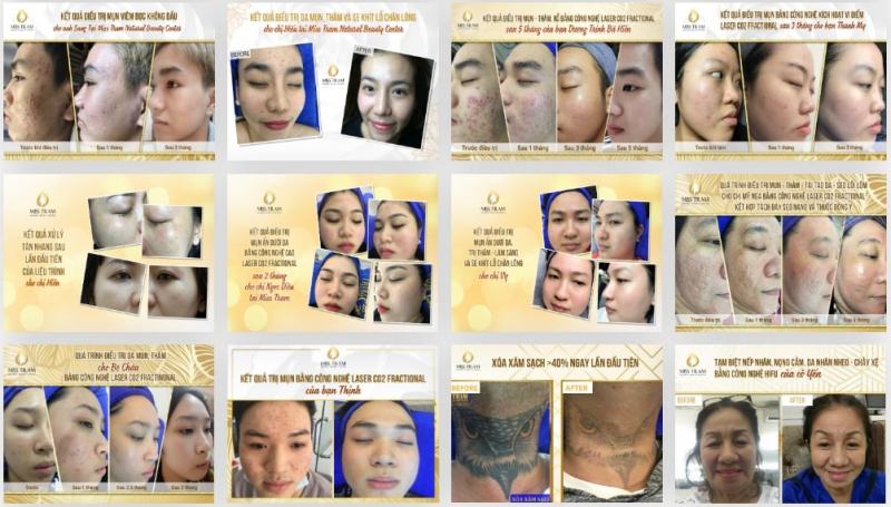 Miss Trâm – Natural Beauty Center: Chuyên trị sẹo rỗ, sẹo mụn có cam kết ở HCM