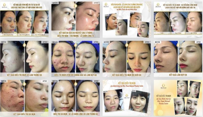 Miss Trâm - Natural Beauty Center: Nơi chuyên điều trị nám, tàn nhang uy tín có cam kết ở HCM