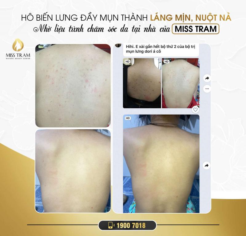 Miss Trâm Spa: Nơi điều trị mụn lưng, viêm nang lông uy tín hơn 15 năm ở HCM