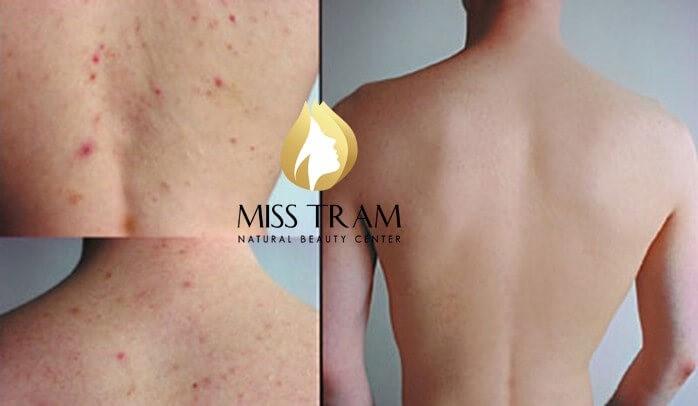 Miss Trâm Spa: Nơi điều trị mụn lưng, viêm nang lông uy tín hơn 15 năm ở HCM